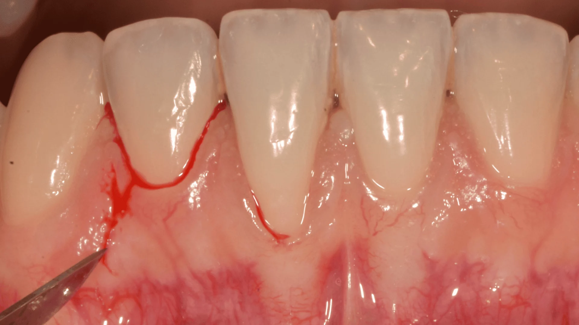 Imagen destacada de Diplomado de Plástica Periodontal y Periimplantaria Aplicada