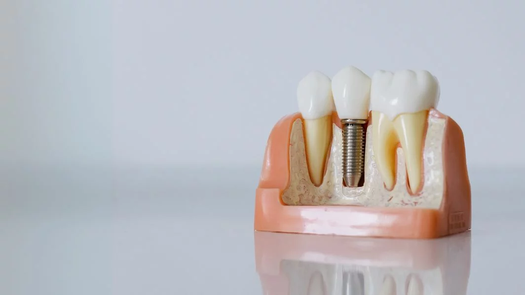 Imagen destacada de Postítulo de Especialidad Odontológica en Rehabilitación Oral, Mención en Prótesis Dento e Implanto Asistidas