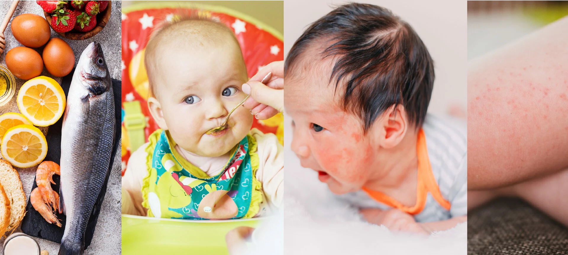 Imagen destacada de Curso Alergia Alimentaria y Reacciones Adversas a Alimentos en Pediatría