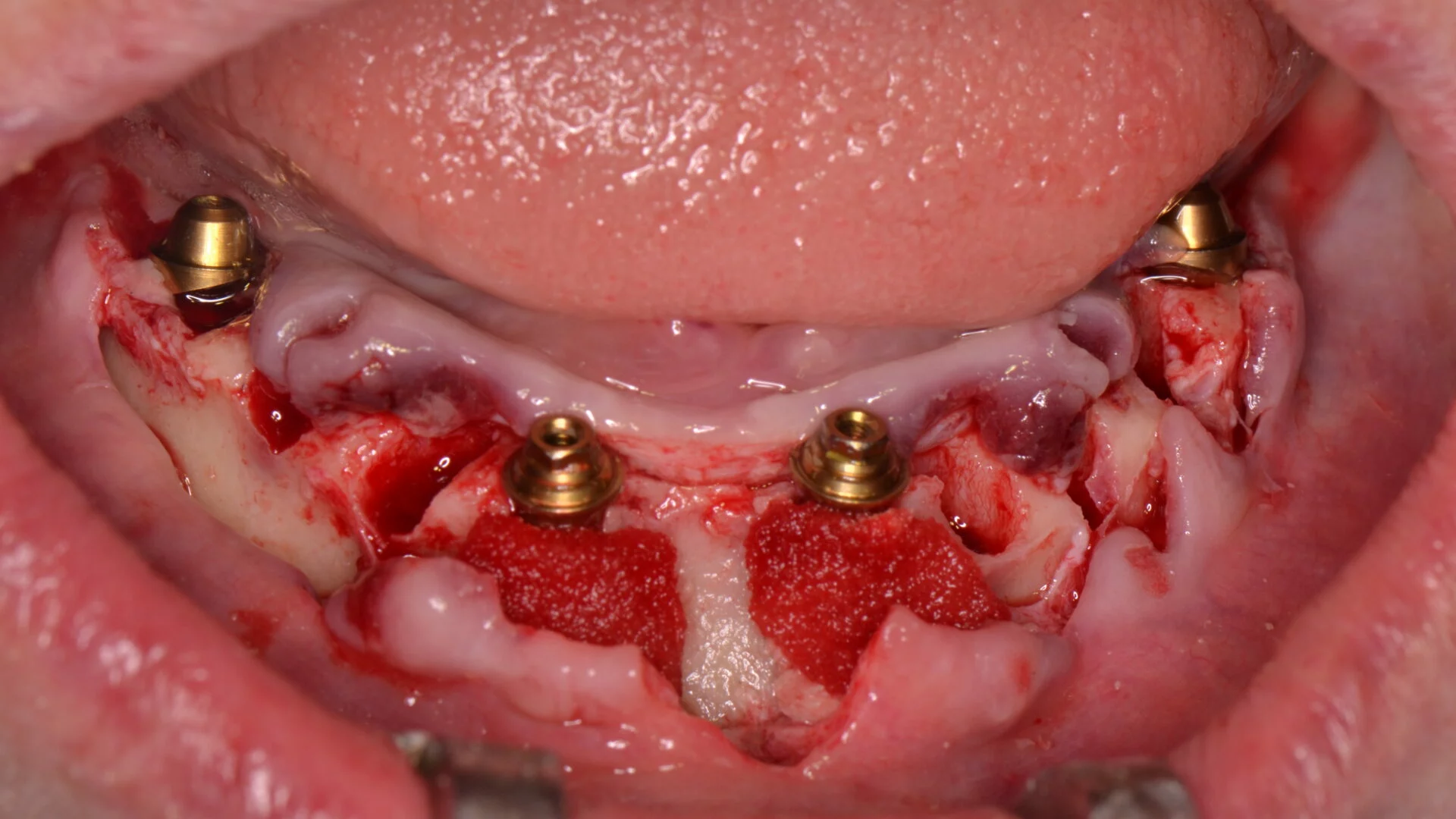 Imagen destacada de Postítulo de Especialidad Odontológica en Implantología Buco Maxilofacial