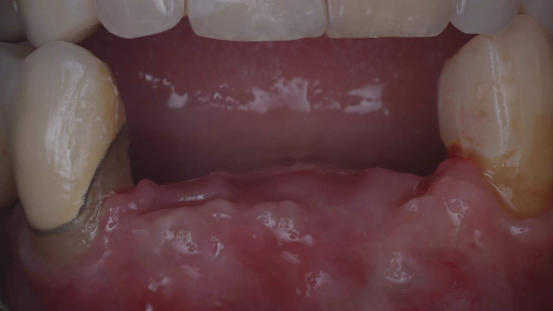 Imagen destacada de Postítulo de Especialidad Odontológica en Implantología